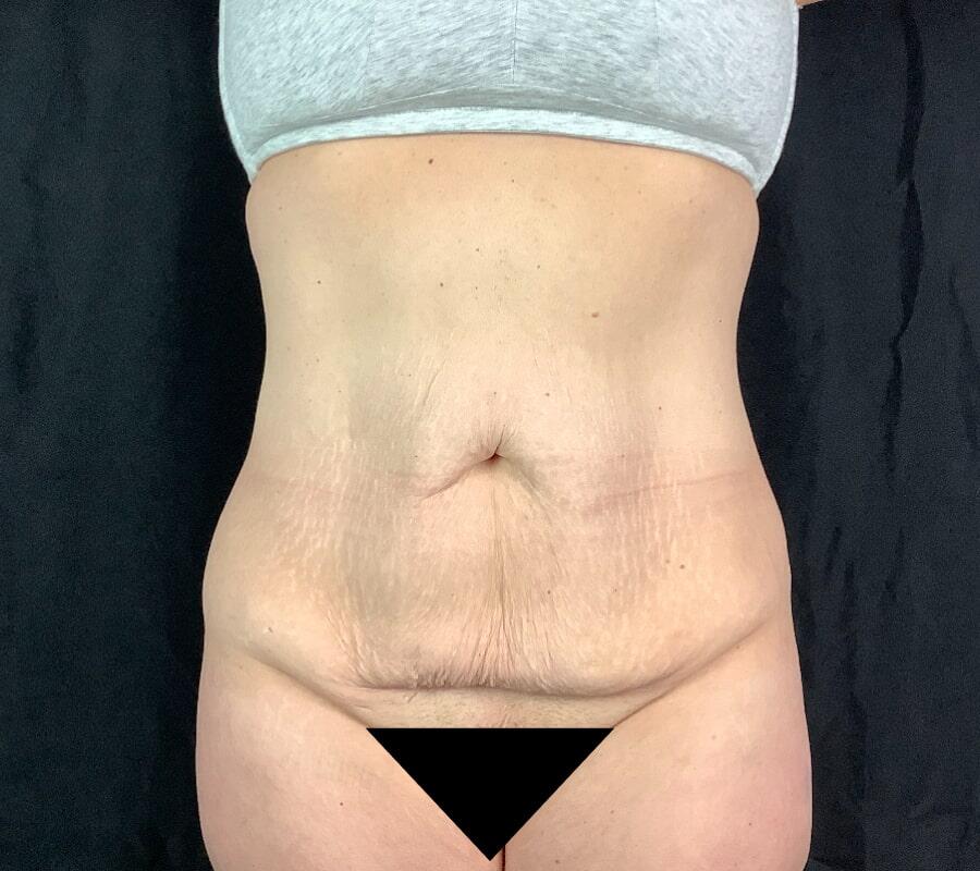 Abdominoplasty Before & After Image