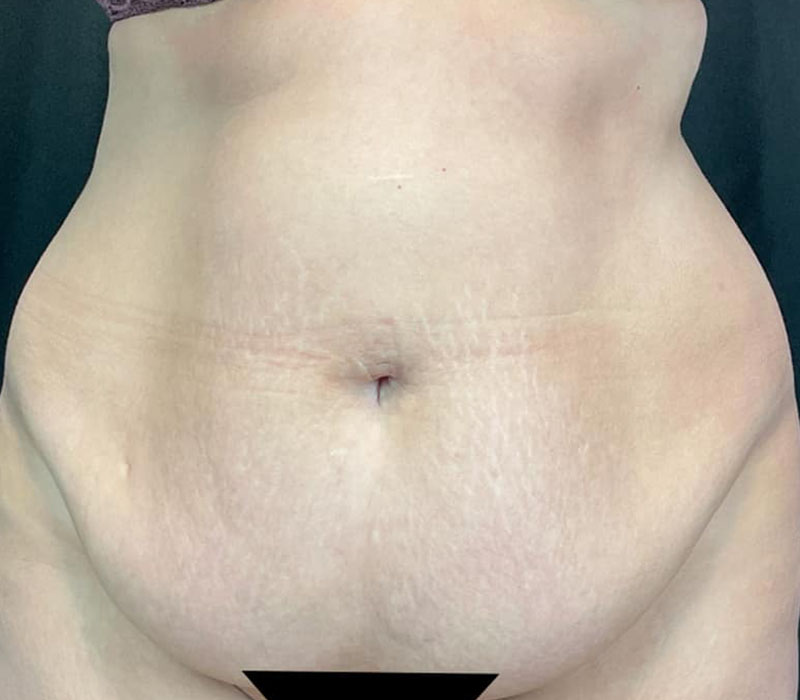 Abdominoplasty Before & After Image