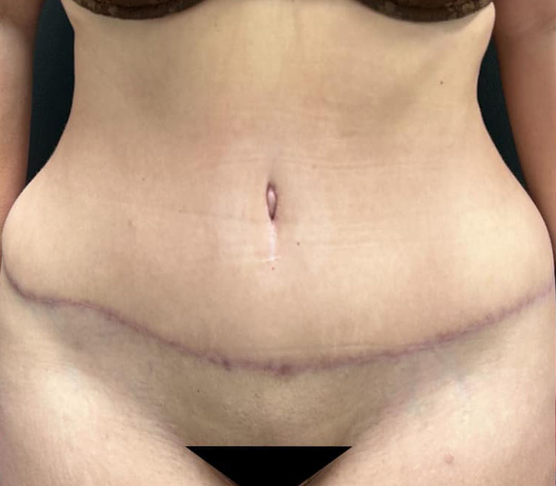 Abdominoplasty Before & After Image