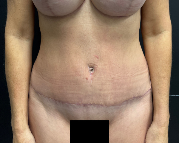 Abdominoplasty Before & After Image