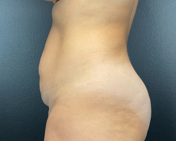 Abdominoplasty Before & After Image