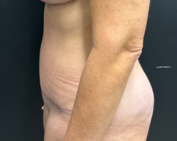 Abdominoplasty Before & After Image