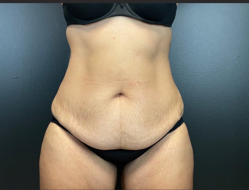 Abdominoplasty Before & After Image