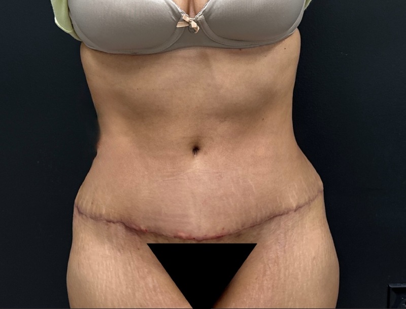 Abdominoplasty Before & After Image