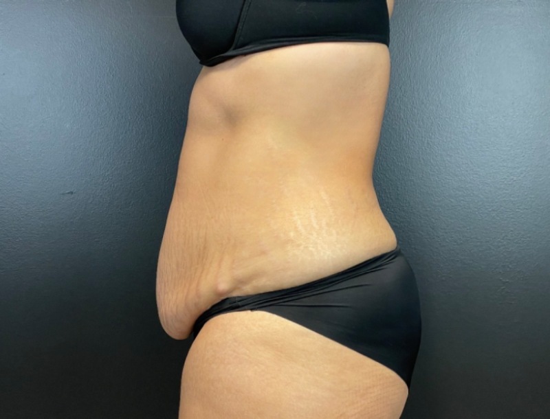 Abdominoplasty Before & After Image