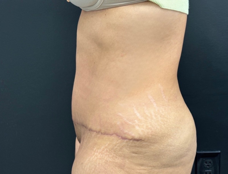 Abdominoplasty Before & After Image