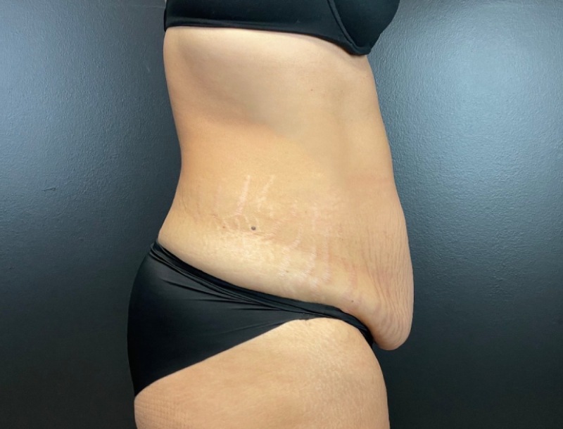 Abdominoplasty Before & After Image