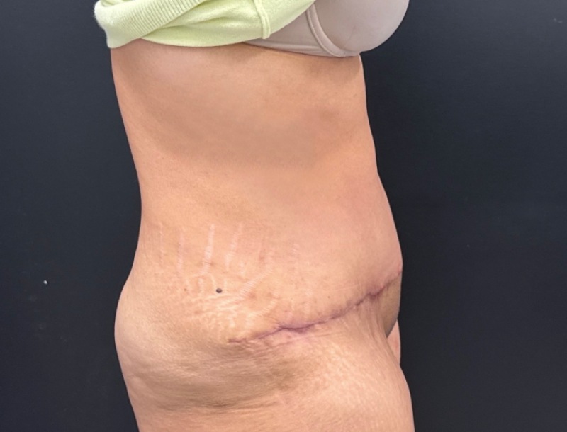 Abdominoplasty Before & After Image