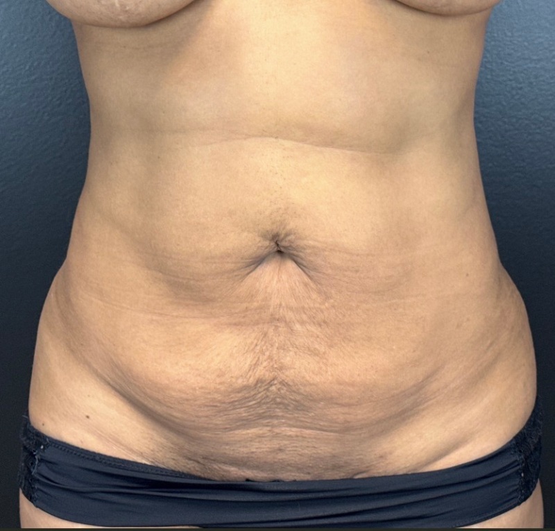 Abdominoplasty Before & After Image