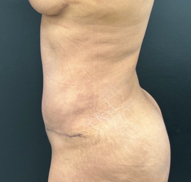 Abdominoplasty Before & After Image