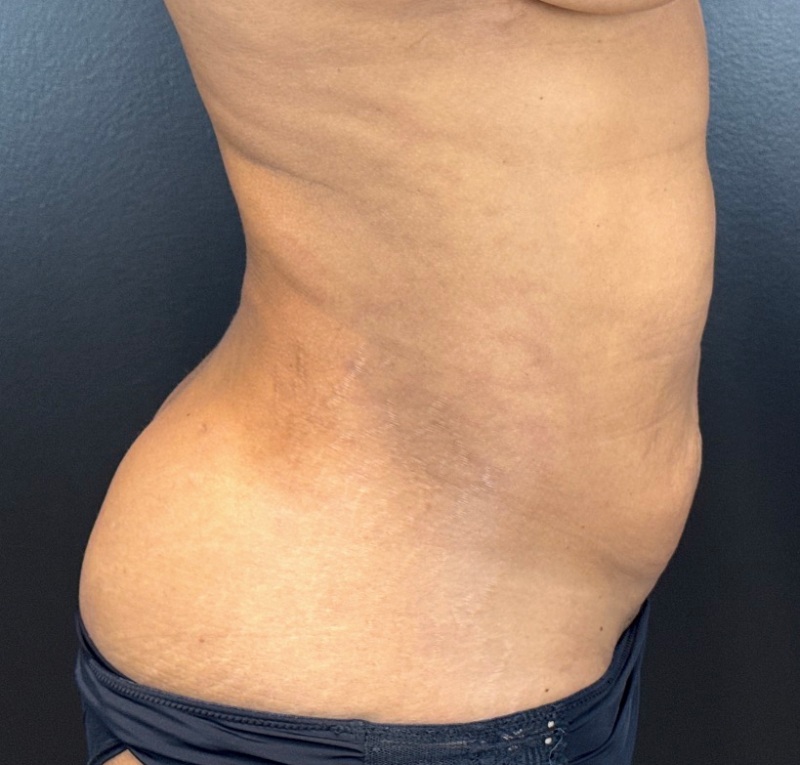 Abdominoplasty Before & After Image