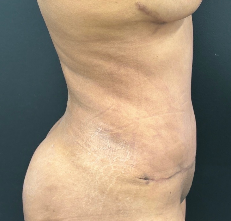 Abdominoplasty Before & After Image