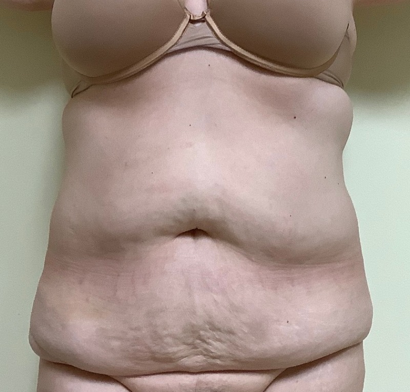 Abdominoplasty Before & After Image