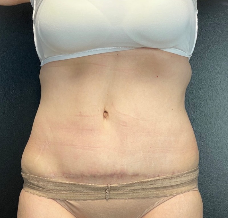 Abdominoplasty Before & After Image