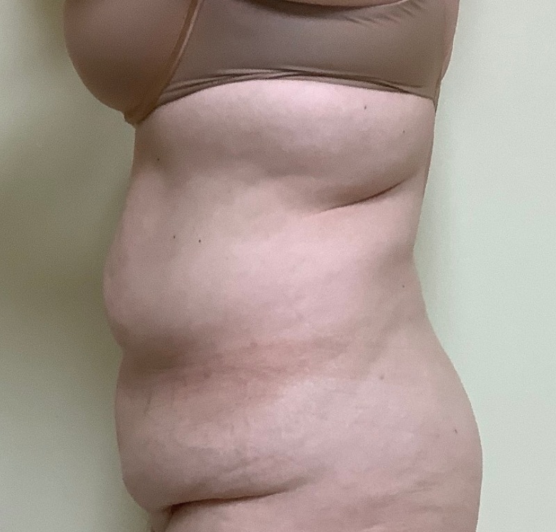 Abdominoplasty Before & After Image