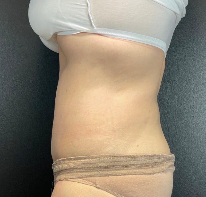 Abdominoplasty Before & After Image