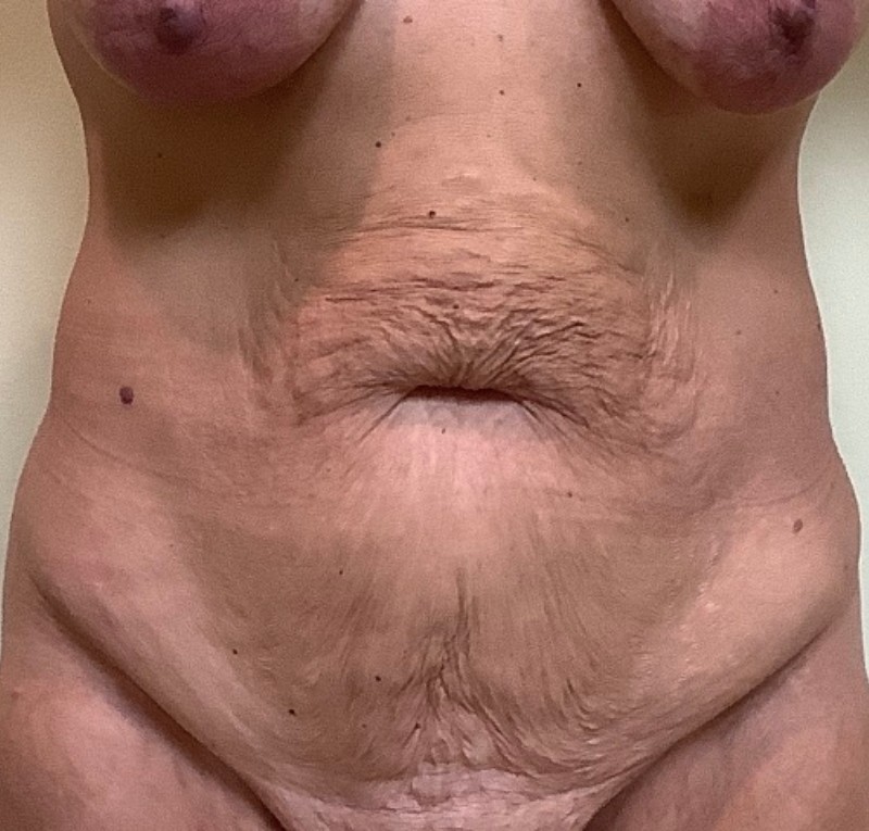 Abdominoplasty Before & After Image