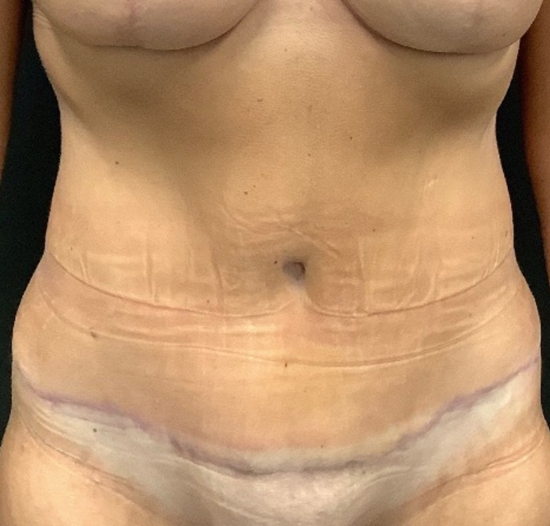 Abdominoplasty Before & After Image