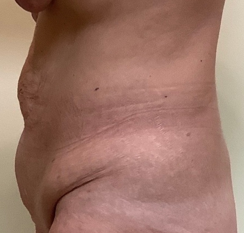 Abdominoplasty Before & After Image