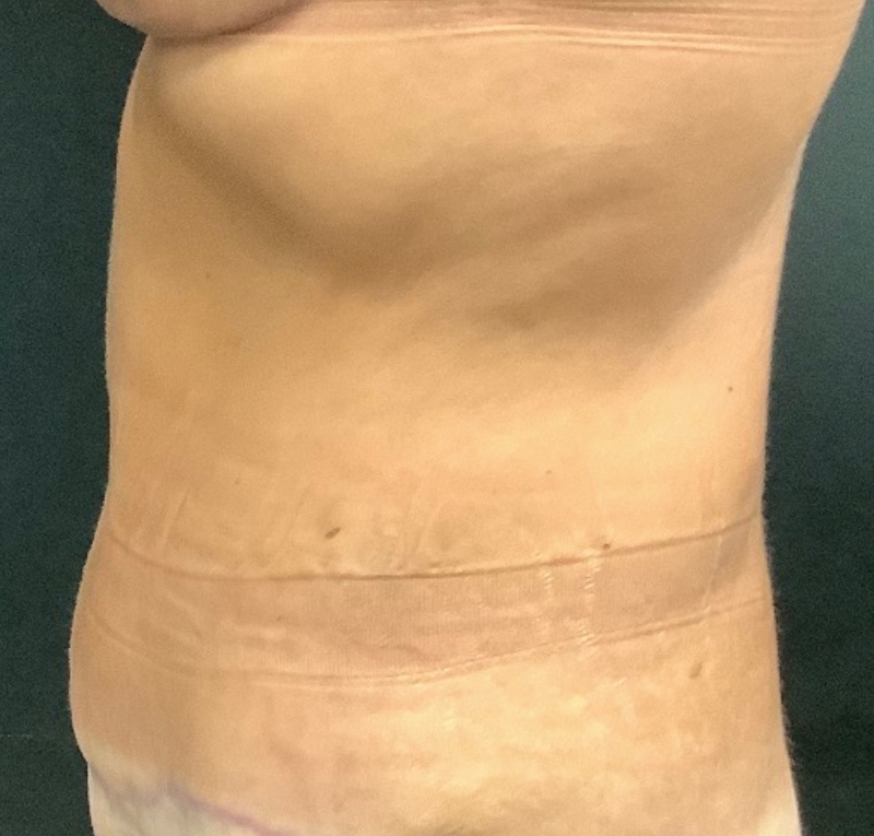 Abdominoplasty Before & After Image