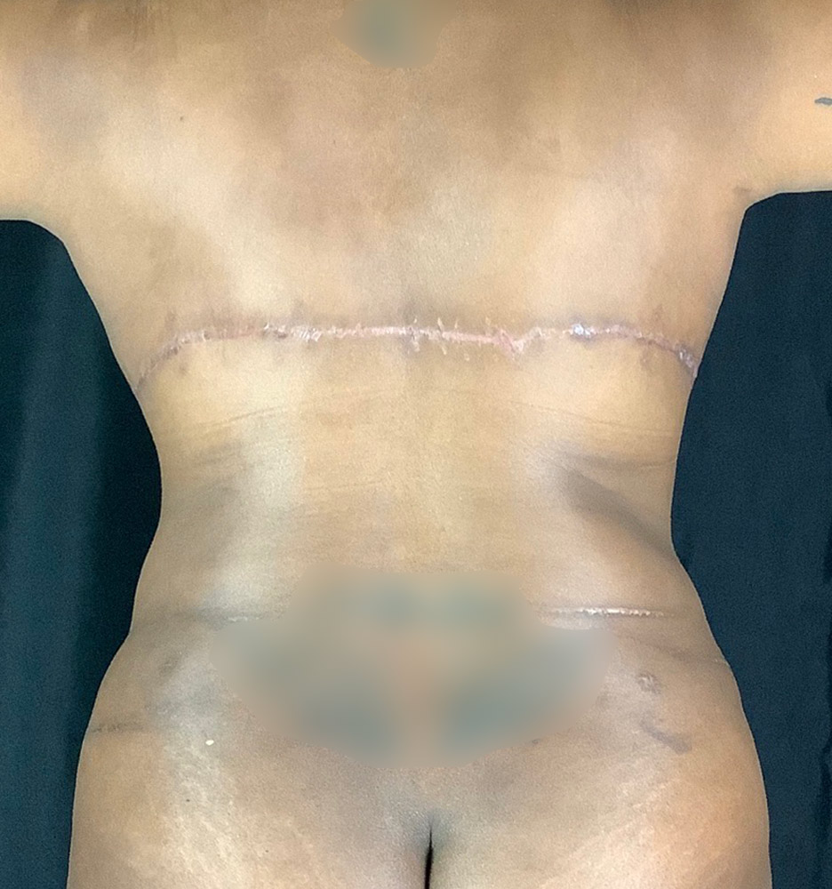 Back Lift Before & After Image