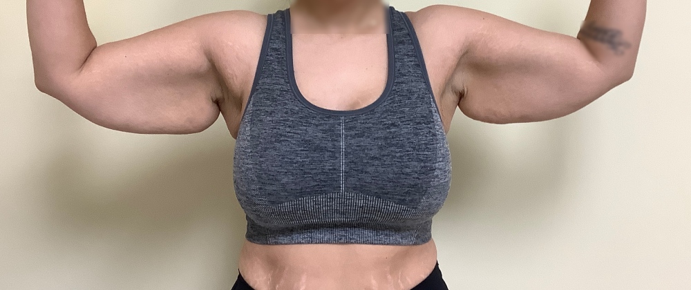 Brachioplasty Before & After Image