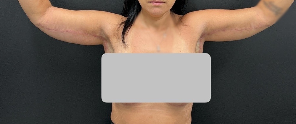 Brachioplasty Before & After Image