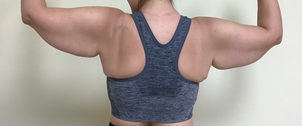 Brachioplasty Before & After Image