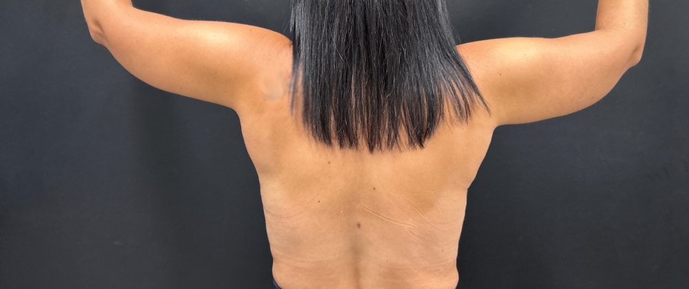 Brachioplasty Before & After Image