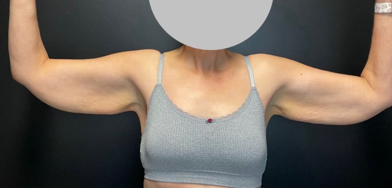 Brachioplasty Before & After Image
