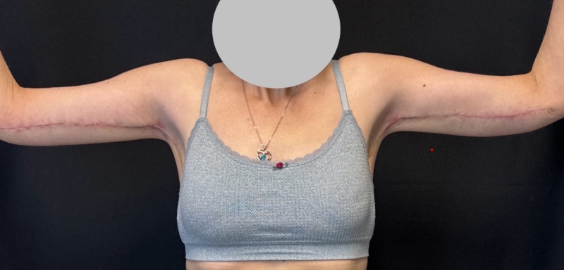 Brachioplasty Before & After Image