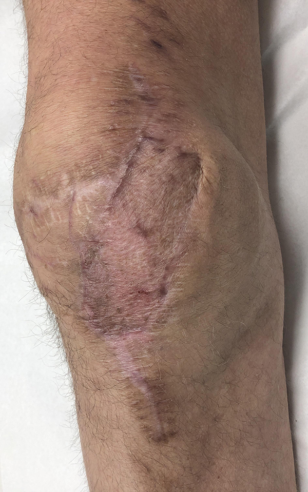 Limb Reconstruction Before & After Image