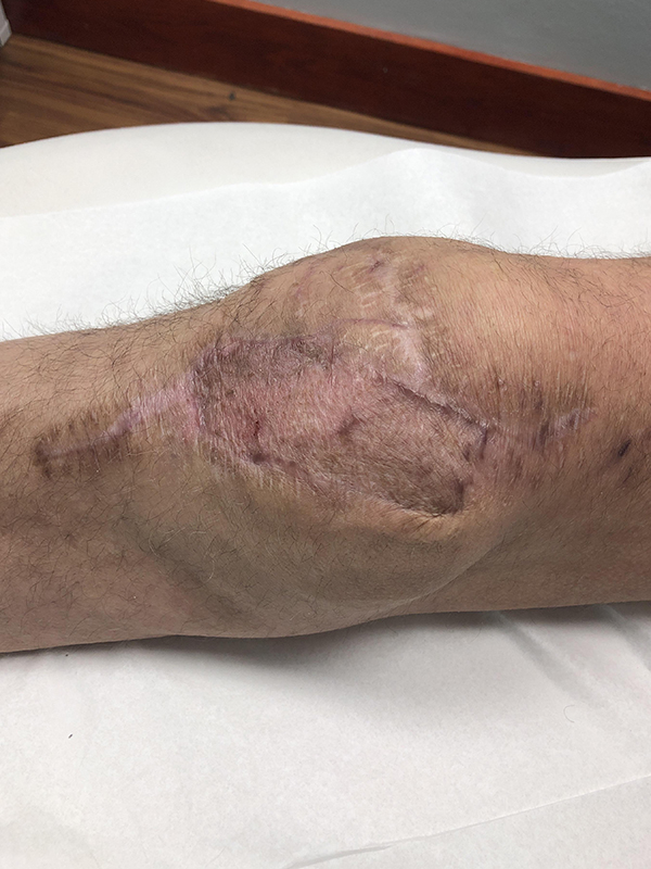 Limb Reconstruction Before & After Image