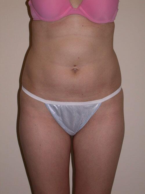 Liposuction Before & After Image