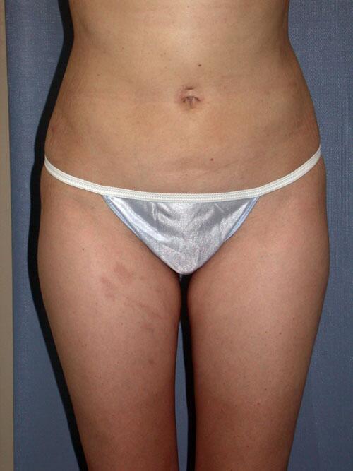 Liposuction Before & After Image