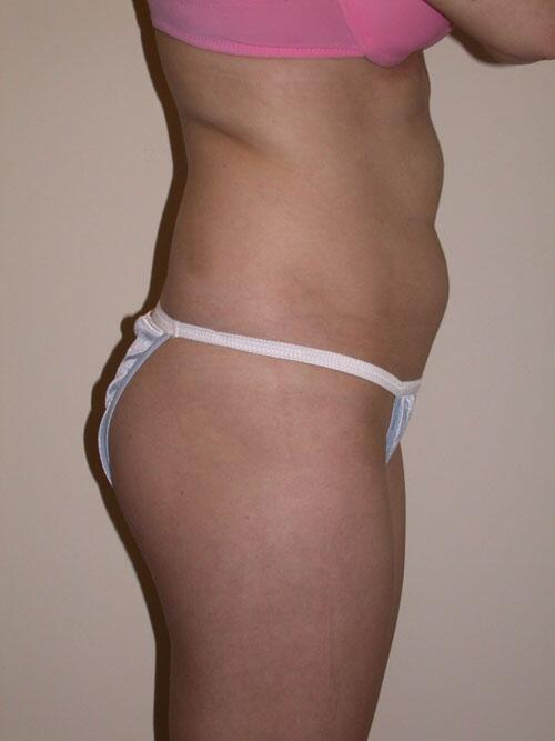 Liposuction Before & After Image