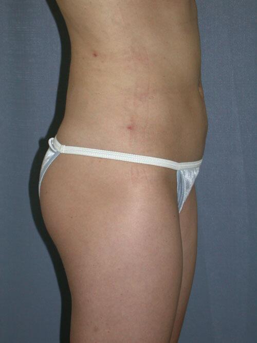 Liposuction Before & After Image