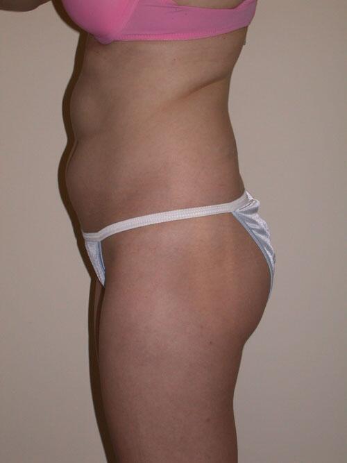 Liposuction Before & After Image