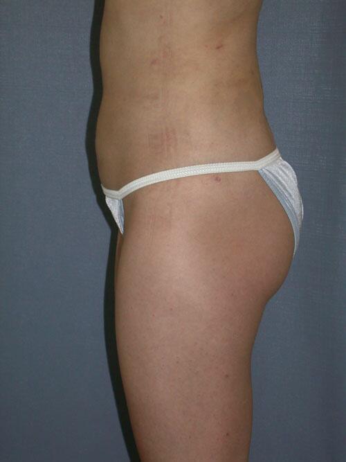 Liposuction Before & After Image