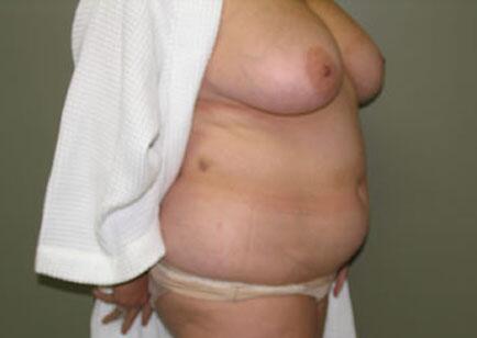 Liposuction Before & After Image