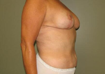 Liposuction Before & After Image