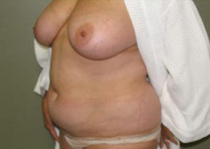 Liposuction Before & After Image