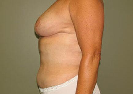 Liposuction Before & After Image