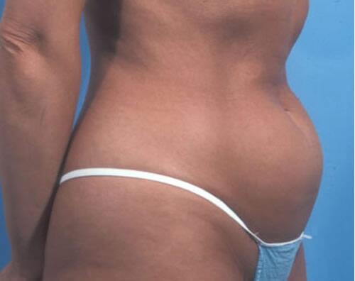 Liposuction Before & After Image