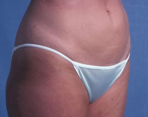 Liposuction Before & After Image