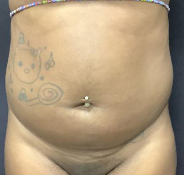 Liposuction Before & After Image