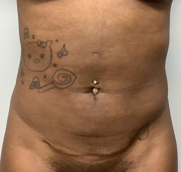 Liposuction Before & After Image