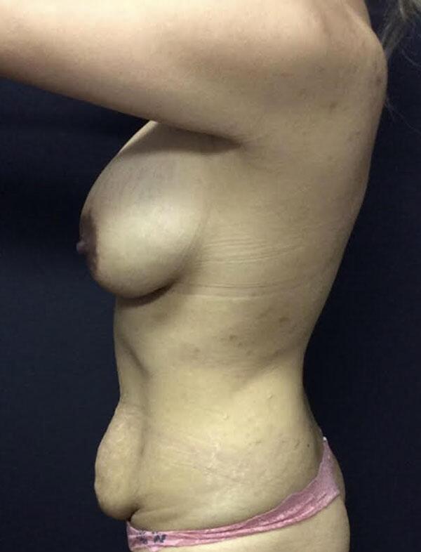 Mommy Makeover Before & After Image