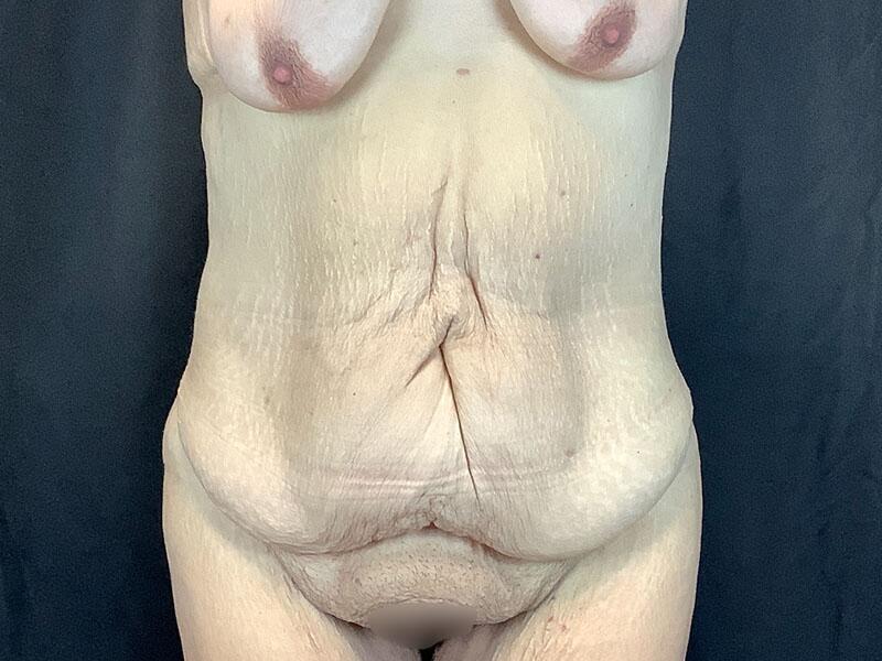 Post Bariatric Body Contouring Before & After Image