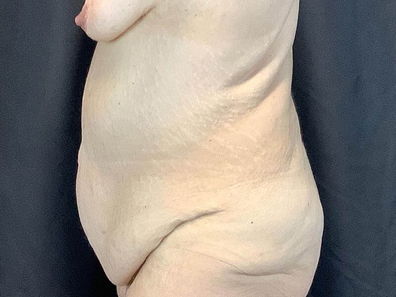 Post Bariatric Body Contouring Before & After Image